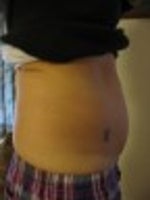 Before smart lipo - side
